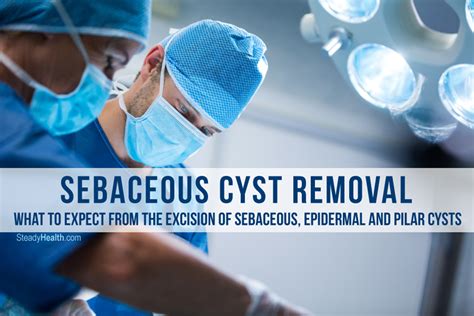 Sebaceous Cyst Removal What To Expect From The Excision Of Sebaceous