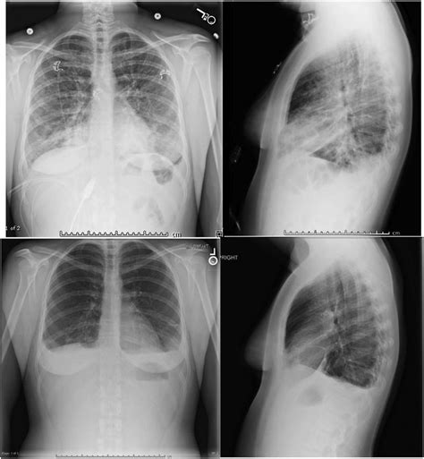 Chest Radiography Before And After Steroids Treatment Top Left And