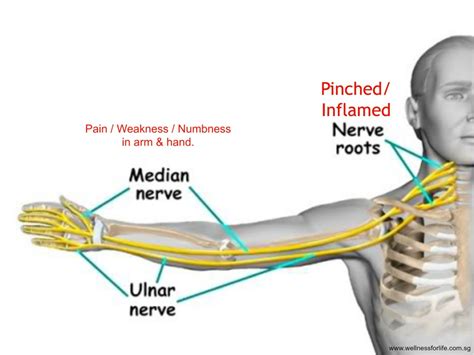 Wellness For Life Chiropractic Numbness Weakness