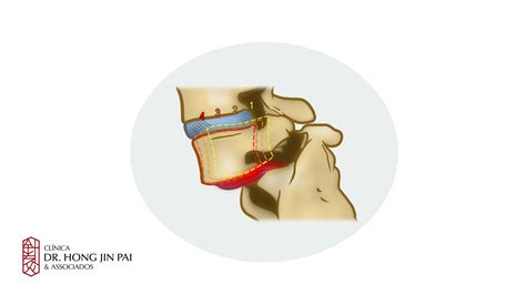 Anterolistese Definição Clínica Dr Hong Jin Pai Dor Fisiatria E