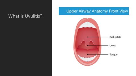 Ppt Understanding Uvulitis Powerpoint Presentation Free Download