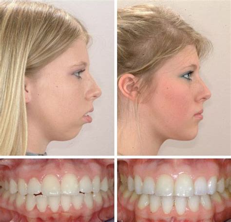 Braces Jaw Overbite Before And After Before And After