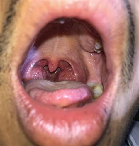 White Spots On Tonsils What Are White Spots On Tonsils Images And