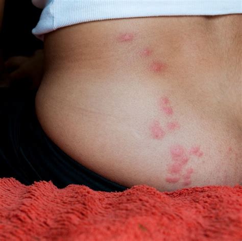These Horrifying Pictures Show Exactly What Bed Bug Bites Look Like