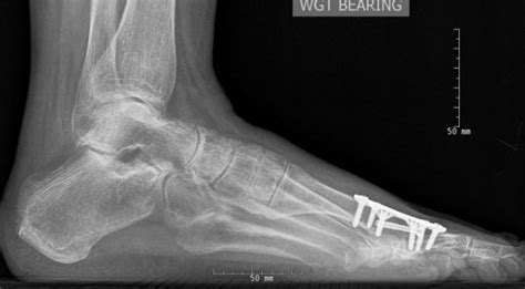 Arthrodesis A Reliable Option For Hallux Rigidus And Failed First Mtp