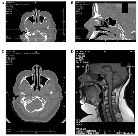 Nasopharyngeal Chordoma In A Patient With A Severe Form Of Sleep