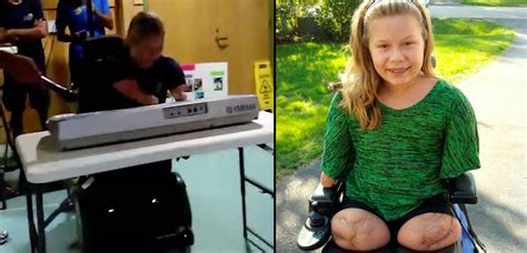 This Girl Lost All Four Limbs Due To A Deadly Bacterial Disease But
