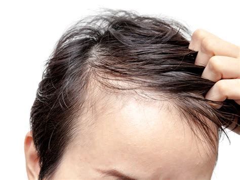 3 Common Questions About A Receding Hairline Hair Loss Reversed