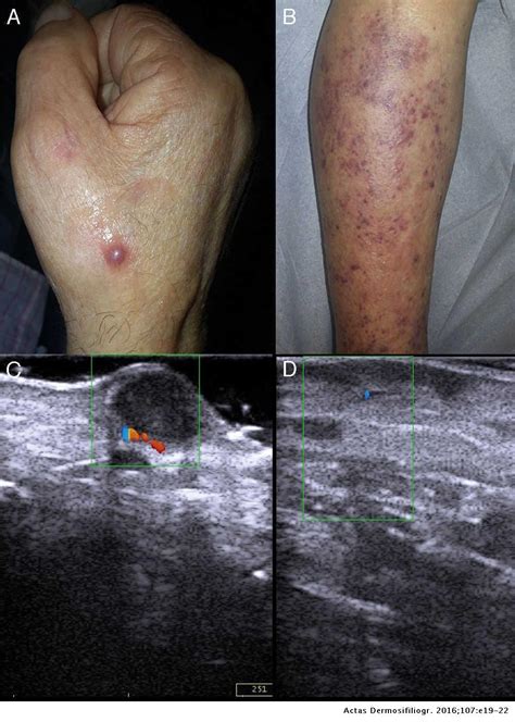 Skin Ultrasound In Kaposi Sarcoma Actas Dermo Sifiliográficas