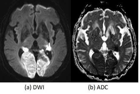 Application Of Diffusion And Perfusion Weighted Imaging In Acute