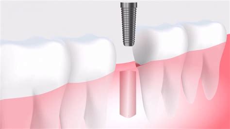 How Safe And Durable Are Dental Implants The Best Dentist In Isfahan