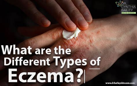 What Are The Different Types Of Eczema Skin Eczema Eczema Face Eczema