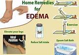 Home Remedies For Oedema Legs Pictures