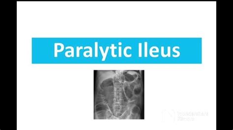 What Is Paralytic Ileus And Causes Methods For Diagnosing Paralytic Ileus Pathology Lecture