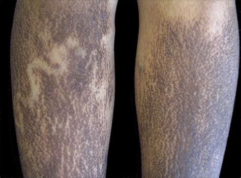 Pruritic Patches On The Back And Papules On The Legs—quiz Case Jama
