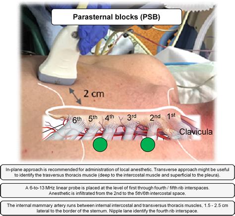 Parasternal Intercostal Nerve Blocks In Patients Undergoing Cardiac