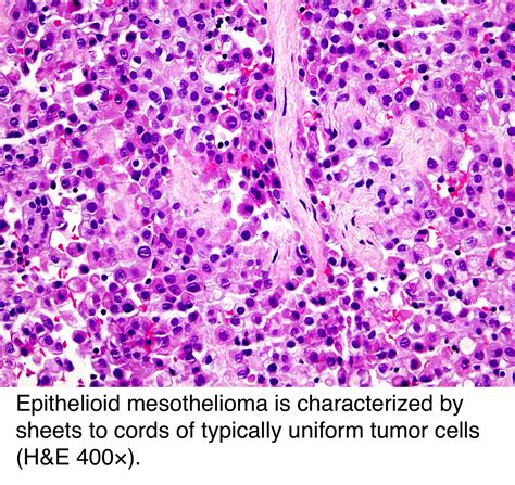 Pathology Outlines Peritoneal Malignant Mesothelioma