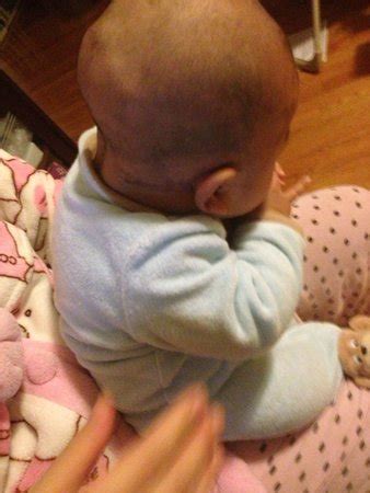 What could this be? answered by dr. 5 month old baby's occipital bone sticks out? - BabyCenter
