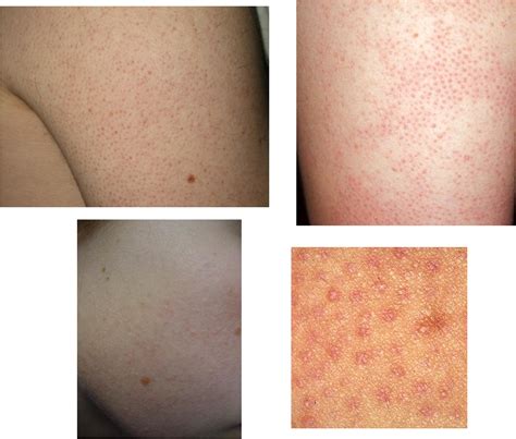 How To Treat Keratosis Pilaris On Arms Dorothee Padraig South West