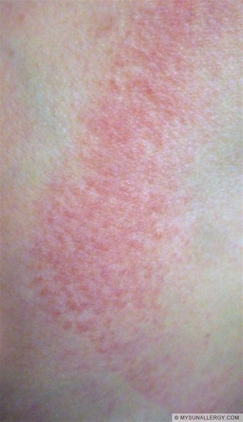 Polymorphous Light Eruption Pmle Picture Pmle Is The Most Common Sun