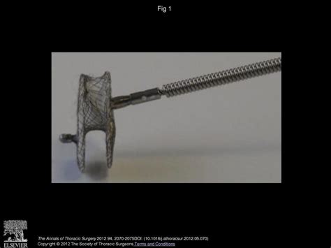 Perventricular Device Closure Of Doubly Committed Subarterial Ventral