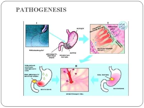 Chronic Gastritis Peptic Ulcer Of A Stomach And