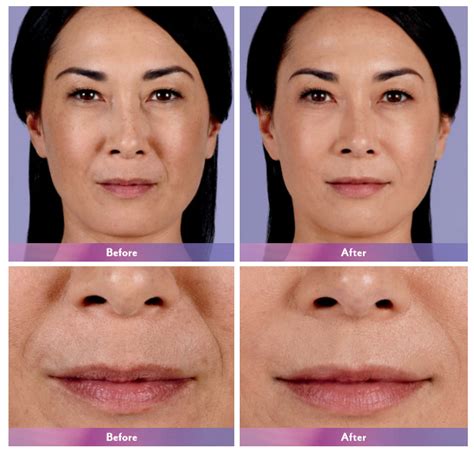 Secret Weapon To Fighting Signs Of Aging Dermal Fillers Dy