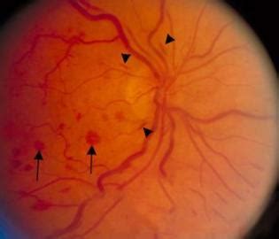 Intraretinal haemorrhages may be 'dot' or' blot' shaped (termed 'dot/blot haemorrhages') or flame shaped depending upon their depth within the retina. Hemorrhages, Deposits, Pigment Abnormalities, elevation ...