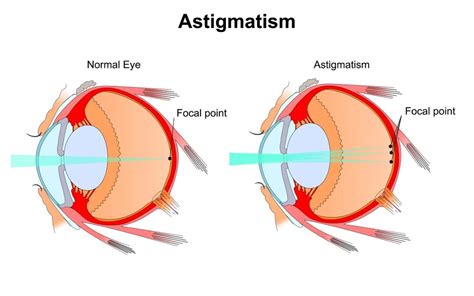 What Is Astigmatism And How Is It Treated Eastside Eye
