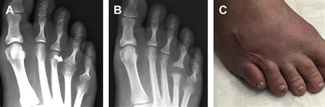 Managing Complications Of Lesser Toe And Metatarsophalangeal Joint