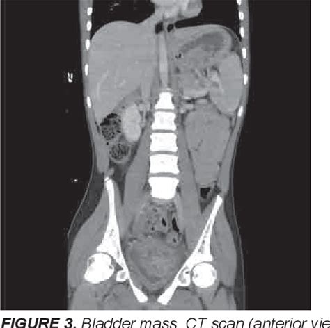 Figure 3 From Role Of Cystitis Glandularis And Intestinal Metaplasia In