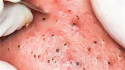 How To Remove Blackheads And Whiteheads On Face Easy 105 Dr Laelia