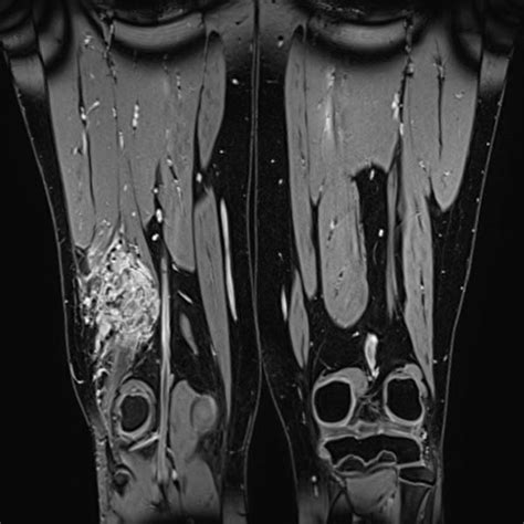 Compva Intramuscular Venous Malformation Thigh