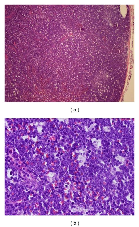 A Lymph Node Biopsy Hande 40x Effaced Nodal Architecture Due To