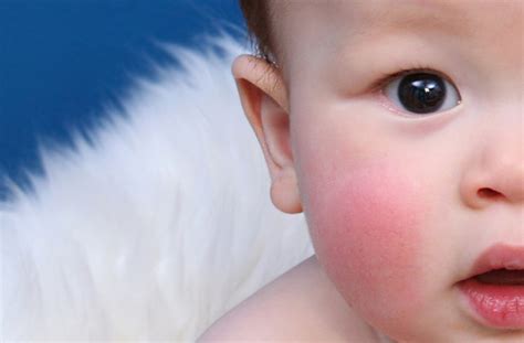 Slapped Cheek Syndrome Signs Symptoms And Treatments Of Slapped Cheek