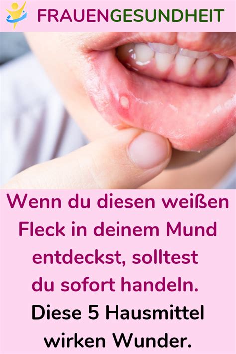 Rauchen schädigt den selbstreinigungsmechanismus der atemwege. Cool Weiße Pickel Um Den Mund