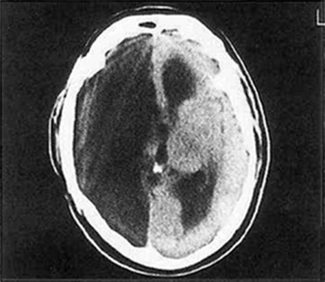 Hemispherectomy For Intractable Seizures Long Term Results In 17