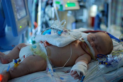 What Is Congenital Diaphragmatic Hernia The Incredible Teddy Foundation