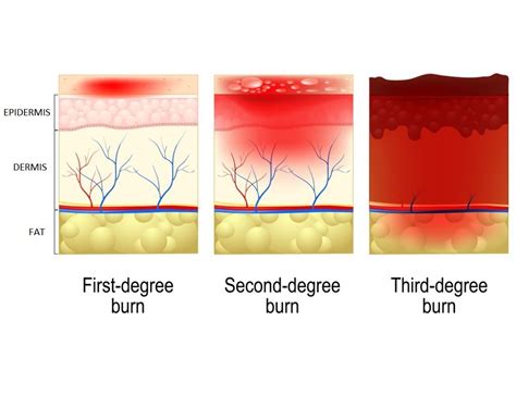 Burn Scar Treatment With Microneedling At Home Derma Roller Shop