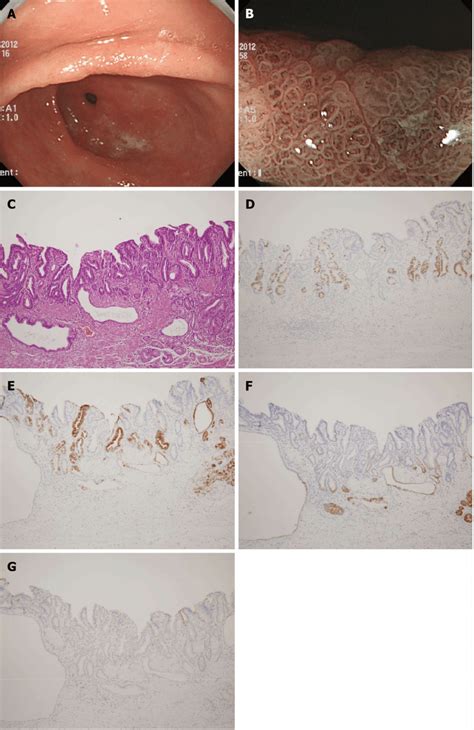 Endoscopic And Histologic Findings Of Foveolar Gastric Epithelial