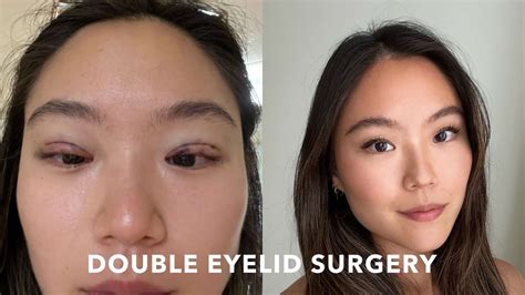I Got Double Eyelid Surgery In Korea Experience Recovery Before