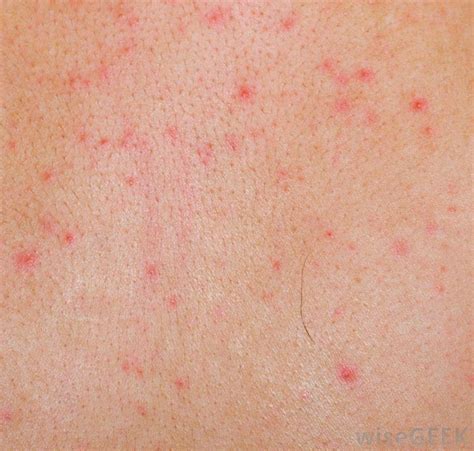 This occurs as the number of red blood cells in the bloodstream goes down. What Causes Petechiae in Children? (with pictures)