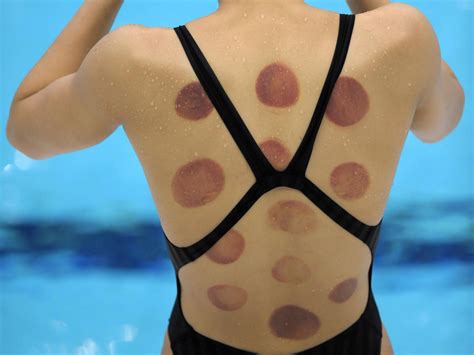 Which i wrote about during the 2016 olympics. Rio 2016: What is 'cupping' and why are Olympic athletes ...
