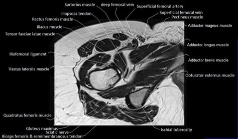 Sterno clavicular joints anatomy & mri protocol. MRI anatomy of hip joint | free MRI axial hip anatomy