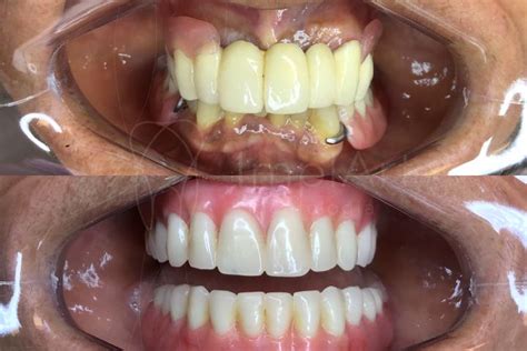 Protesemetaloplasticaantesedepois50kb Implantes Dentários E