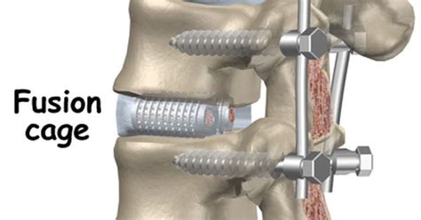 Lumbar Fusion With Cage And Pedicle Screws Spondylolistisis Grade 3 Spinal Fusion Surgery