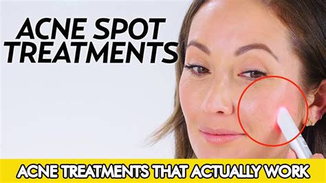 Acne Treatments That Actually Work Top Nine Remedies Loan Nguyen