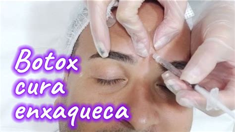 Aplica O De Botox Preventivo Contra Enxaqueca Youtube