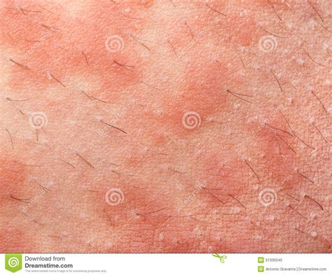 Eczema Atopic Dermatitis Stock Photo Image Of Allergy 51330040