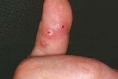 Multiple Cutaneous Reticulohistiocytomas In A Patient With Rheumatoid